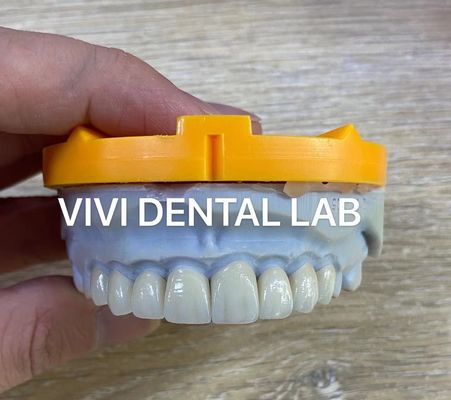 Ivoclar Emax Laminate Veneers ทรานซิลเซนต์ โปรเฟชั่นแนล ระดับสูง China Dental Lab