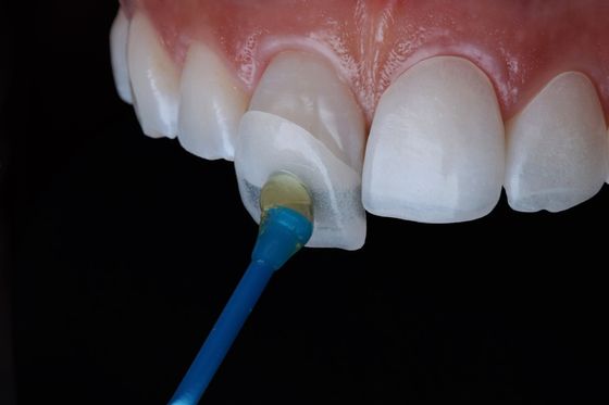 สารประกอบถาวร Emax Zirconia Laminate Veneers ฟันที่ดูธรรมชาติ
