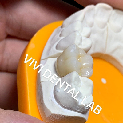 รางวัลห้องปฏิบัติการฟันแข็ง 3D โปร ใสสูง ครบ Zirconia รางวัลห้องปฏิบัติการฟันจีน