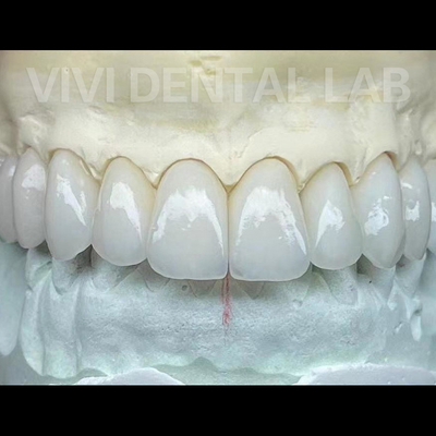 ห้องปฏิบัติการฟัน Zirconia กษัตริย์และงานสะพาน