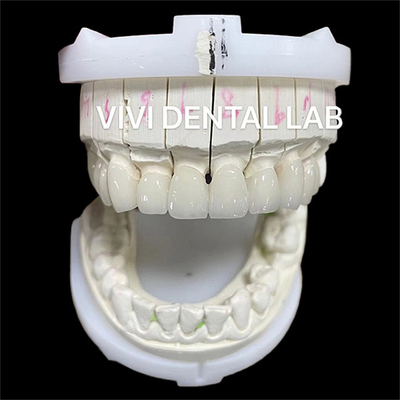 สวยงามสูง Zirconia ฟันแล็บมงคลสะพานที่มี porcelain ชั้น