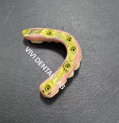 สะพานซิกอร์คอนีย์เต็ม พร้อมทิตาเนียม แบร์สนับสนุน China Dental Lab