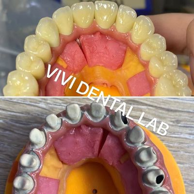 Ivoclar Digital Dental Crowns Process Noritake โปรเซลีน ความแม่นยําสูง
