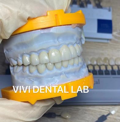 ฟันสวยงามสูง Emax Laminate Veneers ขัดกระดุม