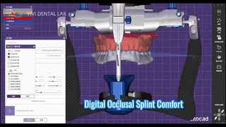 Digital Occlusal Splint ความสบายที่แม่นยำ