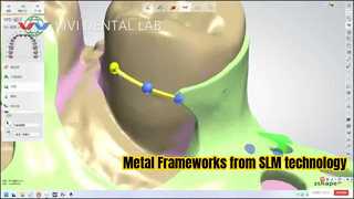 Metal Partial Framework จากเทคโนโลยี SLM